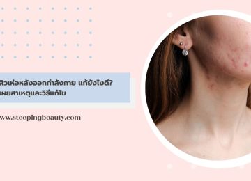 สิวเห่อหลังออกกำลังกาย แก้ยังไงดี? เผยสาเหตุและวิธีแก้ไข